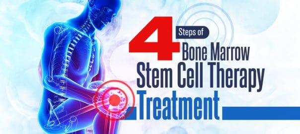 4 steps of bone marrow stem cell therapy treatment 5fefa87f42ee7