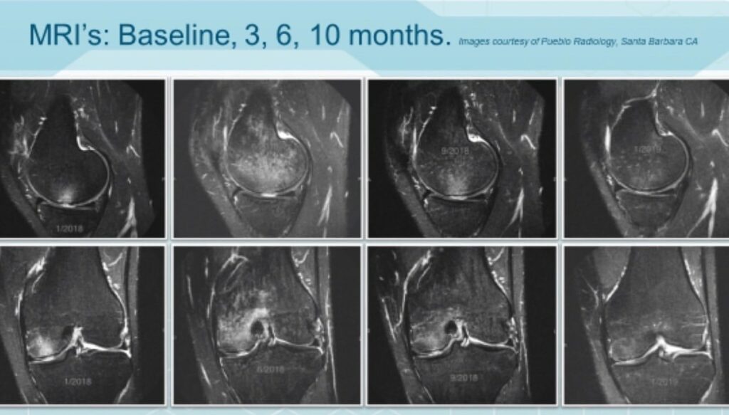 bone edema progression