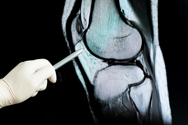 knee-cartilage