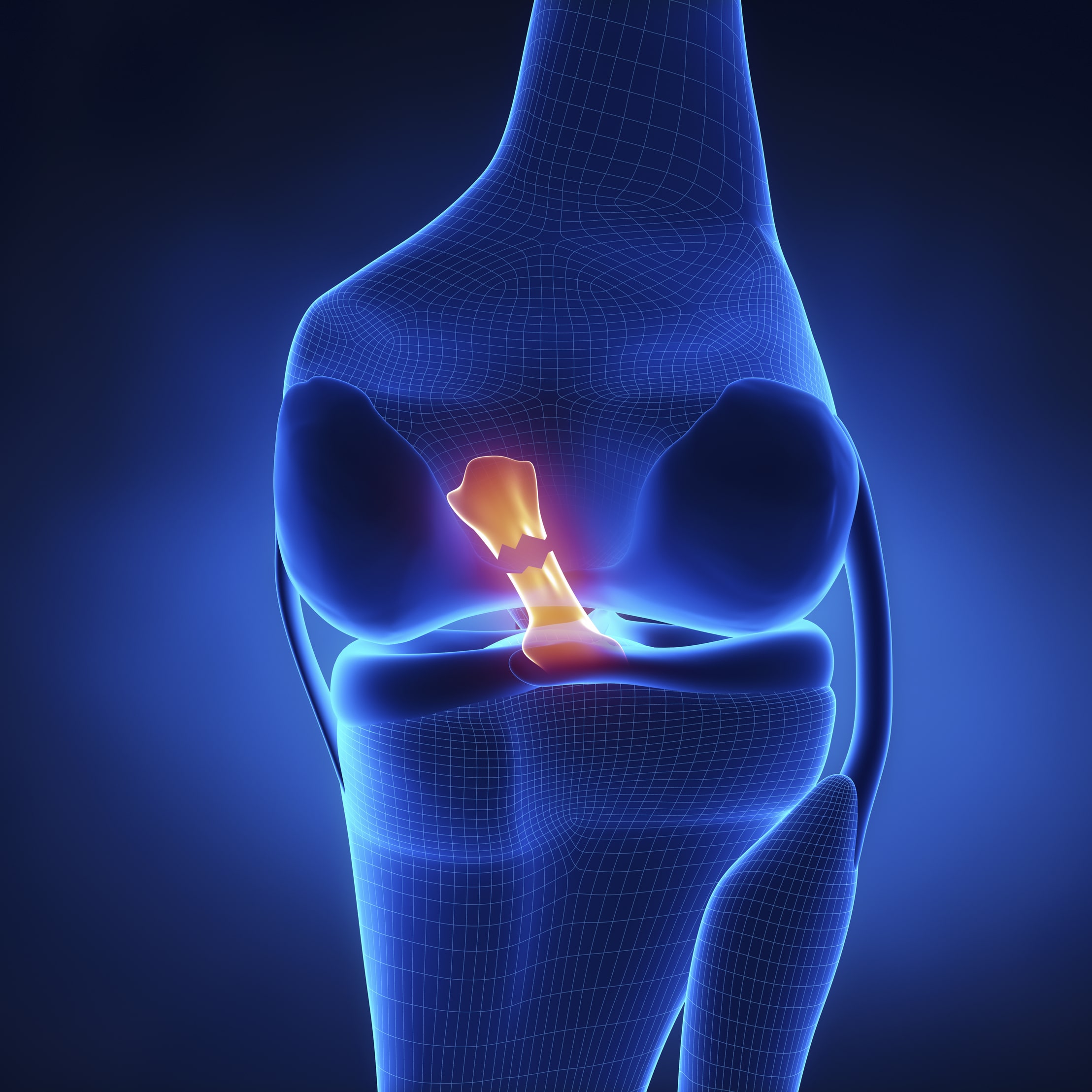 Torn Anterior Cruciate Ligament in x-ray view