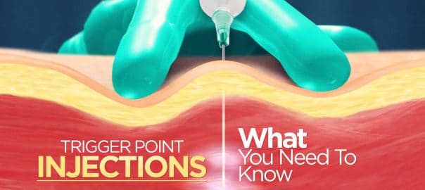 trigger point injections what you need to know 5fefafd271958