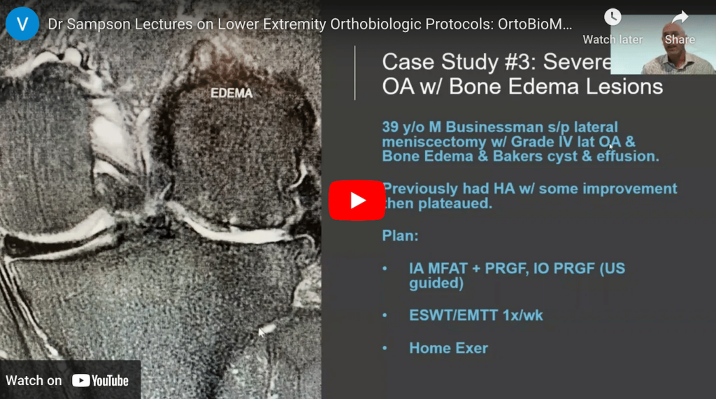 dr steven sampson lectures on prp bone marrow adipose